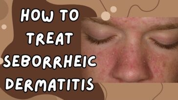 Natural Remedies for Seborrheic Dermatitis: Relief and Healing